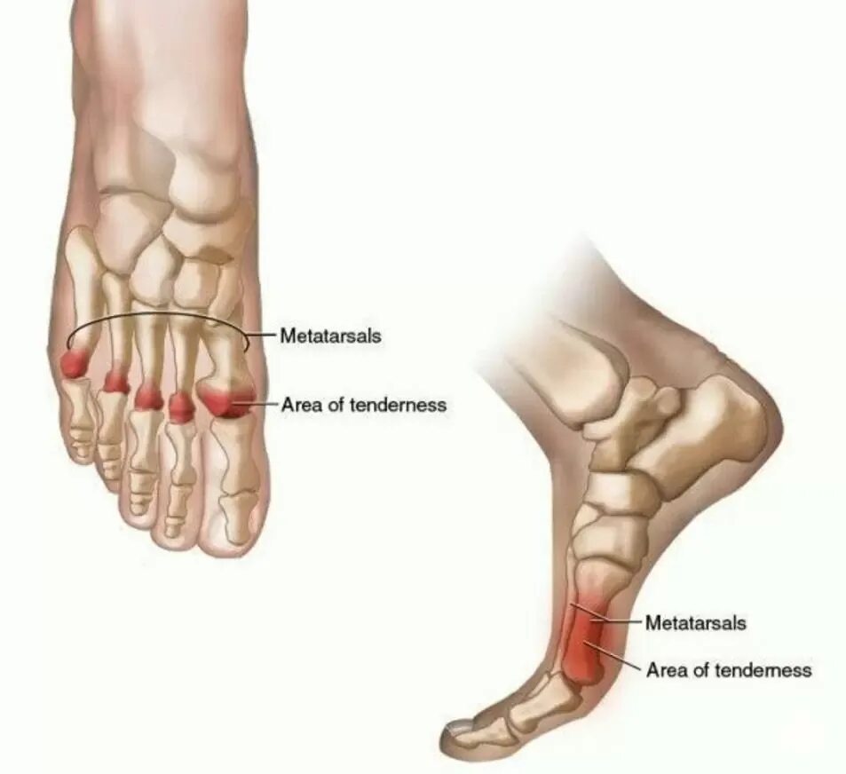 Сильно болят кости. Мортоновская метатарзалгия. Синдром Мортона неврома Мортона. Метатарзальная кость стопы. Травма плюсневой кости.