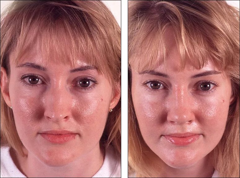 как избавиться от нитей на лице