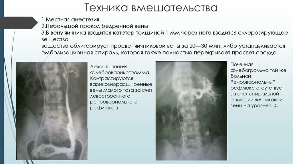 Варикоз органов таза у женщин. Варикозное расширение левой яичниковой вены. Варикозно расширенные вены малого таза. Дилатация вен малого таза. Варикозное расширение параметральных вен малого таза.