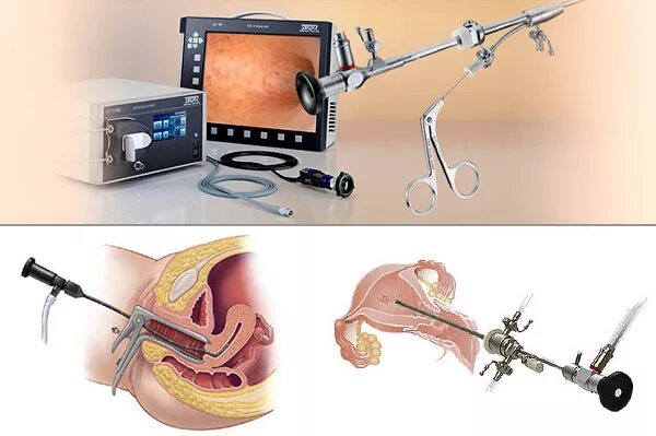 Выскабливание как проводится. Операция гистероскопия. Операция гистерорезектоскопия полипа эндометрия. Операция гистероскопия матки. Гистерорезектоскопия миомы.