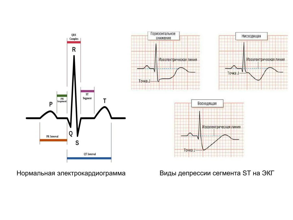 Депрессия сегмента st. Депрессия сегмента St до 0.5 мм на ЭКГ. ЭКГ депрессия сегмента St 1.0 мм. Элевация и депрессия сегмента St на ЭКГ. Депрессия сегмента St на ЭКГ В 2,3 И АВФ.