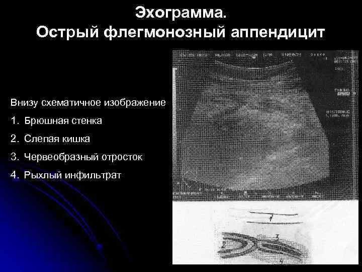 Острый флегмонозный аппендицит. Флегмонозный аппендицит, эмпиема отростка. Острый калькулезный флегмонозный аппендицит. Острый флегмонозный аппендицит препарат. Мкб слепой кишки