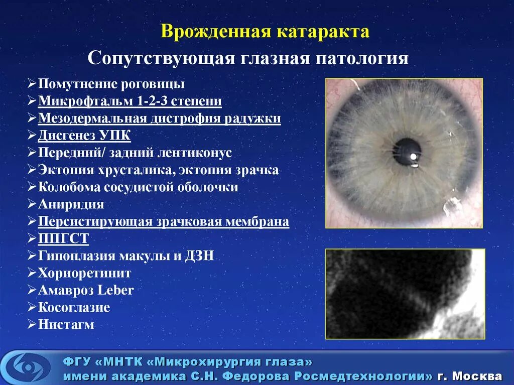 Глаукома код по мкб 10. Врожденная катаракта персистирующая зрачковая мембрана. Врожденная Полярная катаракта характеризуется. Капсулярная врожденная катаракта. Врожденные аномалии роговицы.