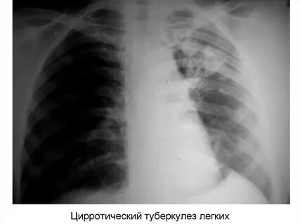 Кавернозно цирротический туберкулез