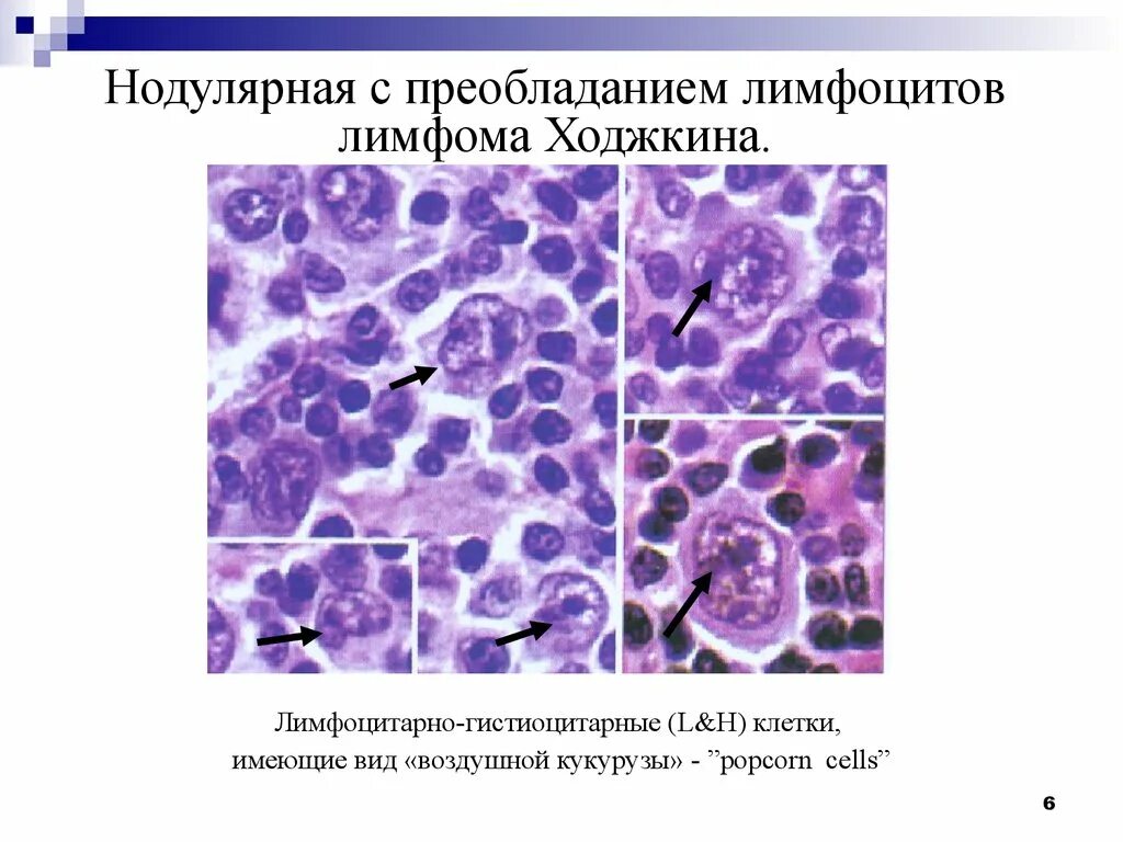 Лимфома лимфатические узлы. Лимфогранулематоз нодулярный склероз микропрепарат. Клетки Рид-Березовского-Штернберга. Клетки попкорн при лимфоме Ходжкина. Нодулярная лимфома Ходжкина клетки.