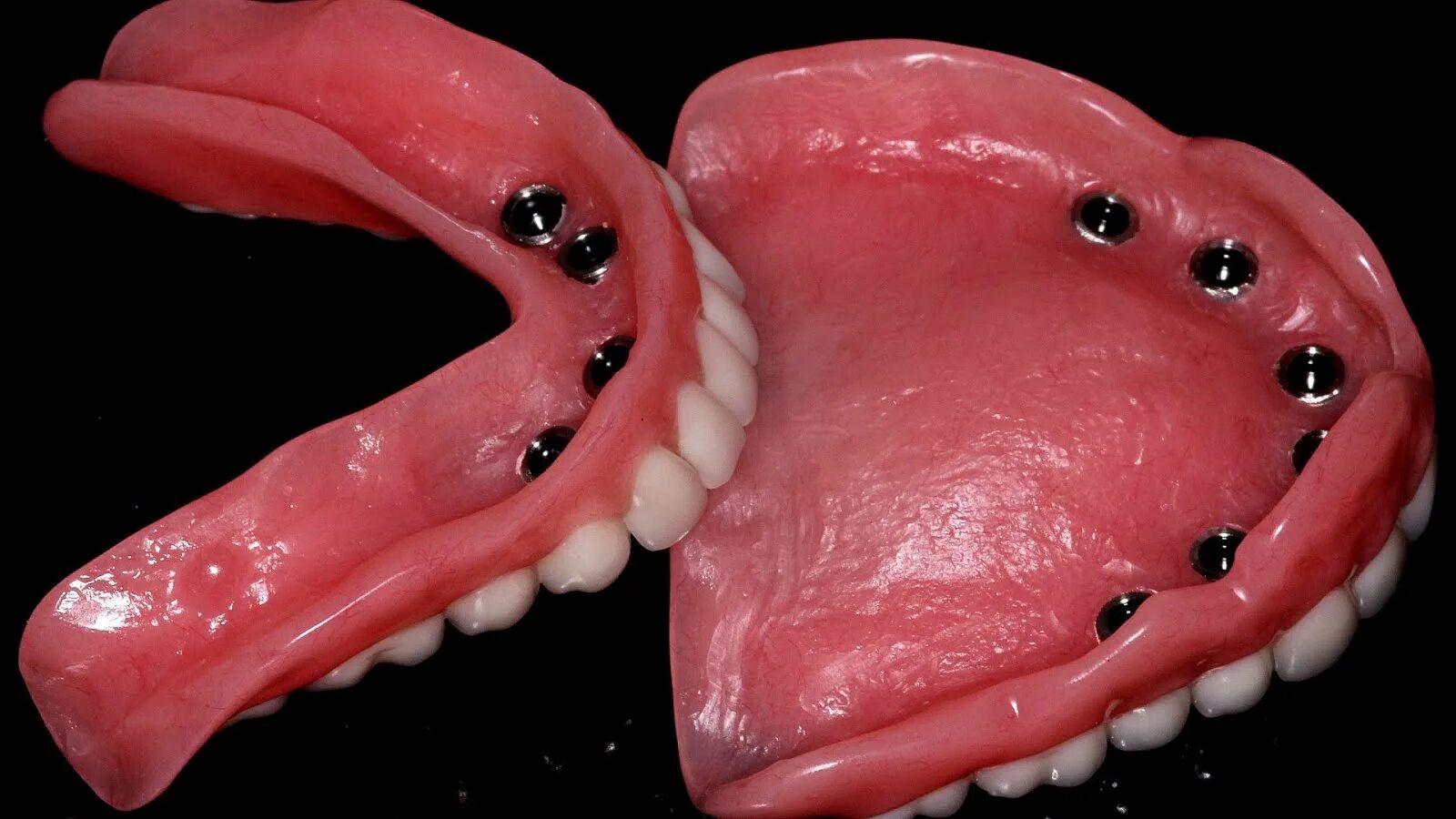 условно съемный протез на имплантатах. мостовидный протез на имплантах на 4 зуба нижней челюсти. имплантологическая кассета nobel полный набор для all on 4. несъемные зубные протезы на 4 имплантах. протез на 4 зуба нижней челюсти.