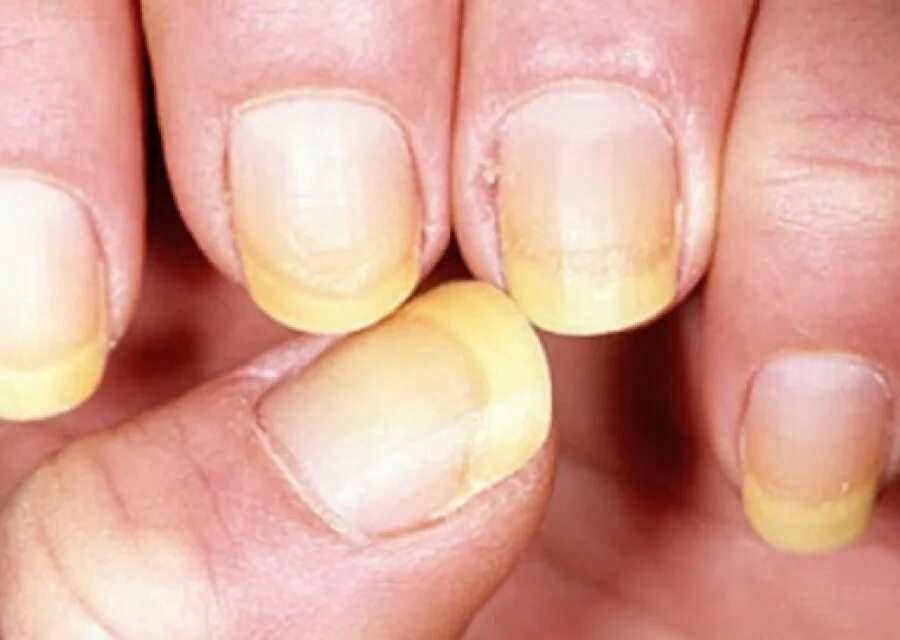 Пожелтение ногтевой пластины. Грибковые заболевания ногтей. Доктор по ногтям