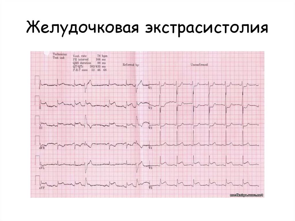 ЭКГ монотопные желудочковые экстрасистолы. Желудочковые экстрасистолы на ЭКГ. Желудочковая экстрасистола на кг. Желудочковые экстрасистолы 1:1. Типы желудочковых экстрасистол