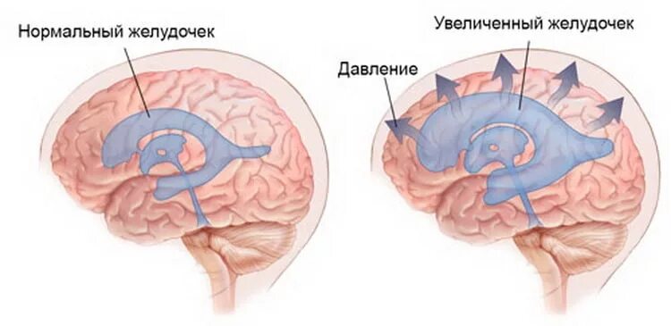 Патологии желудочков головного мозга. Гидроцефалия желудочков головного мозга. Клинические симптомы гидроцефалии. Гидроцефалия четвертого желудочка.