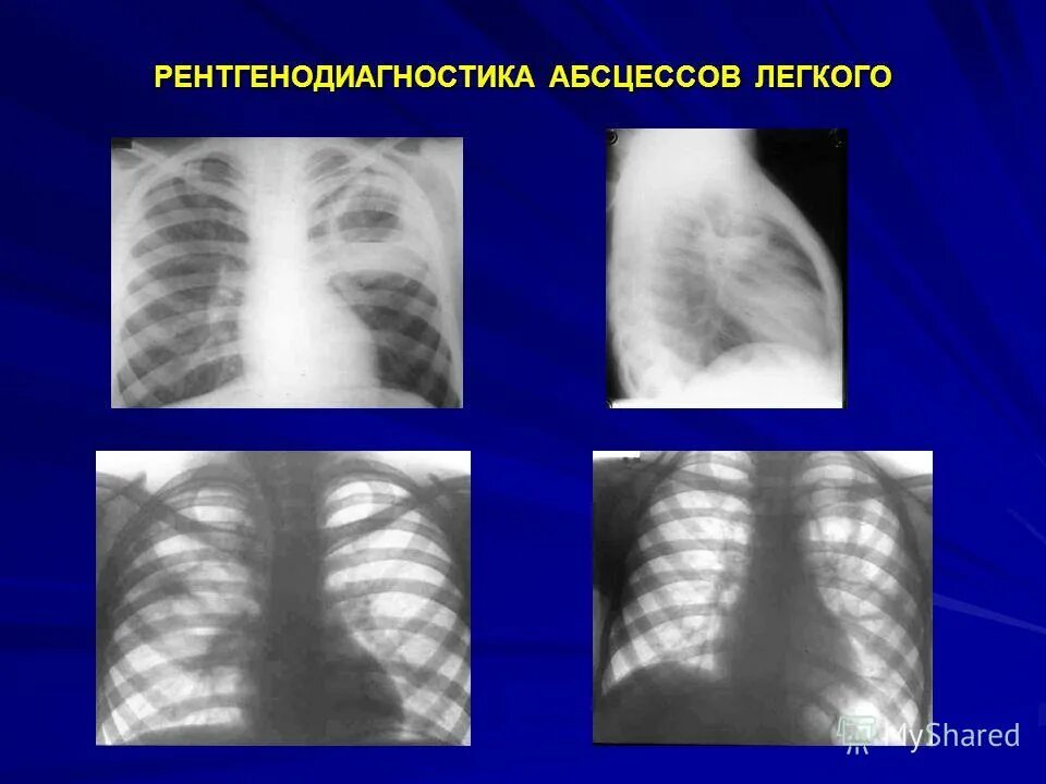 Гнойные абсцессы легких. Дренирующий абсцесс легкого рентген. Рентгенодиагностика абсцесса легкого. Дренирующий острый абсцесс легкого. Абсцесс и гангрена легкого рентген.