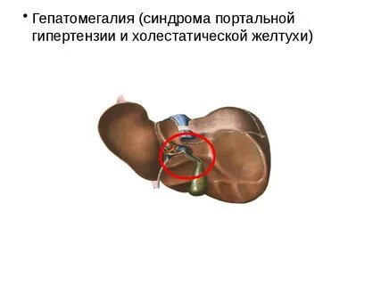 Печень выступает на 1 см