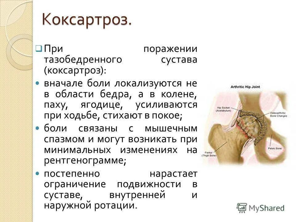 Боли при коксартрозе тазобедренного сустава где болит. Коксо артроз бедренного сустава. симптомы коксартроза тазобедренного сустава. коксартроз тазобедренного симптомы. заболевания тазобедренного сустава у женщин.