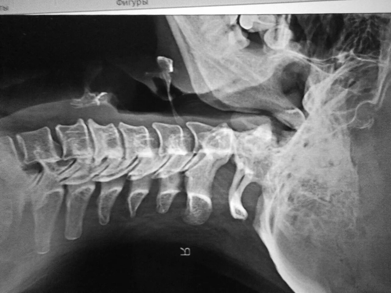 Грыжа шейного позвоночника. Грыжа шейного отдела снимки. Грыжа в шейном отделе снимок.