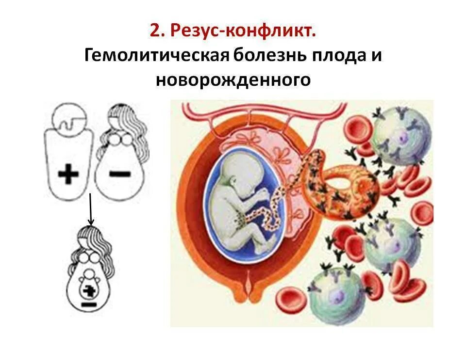 Резус фактор плода по крови. Гемолитическая болезнь резус конфликт. Гемолитическая болезнь плода резус конфликт. Наследование rh фактора гемолитическая болезнь плода. Гемолитическая болезнь новорожденных (ГБН).