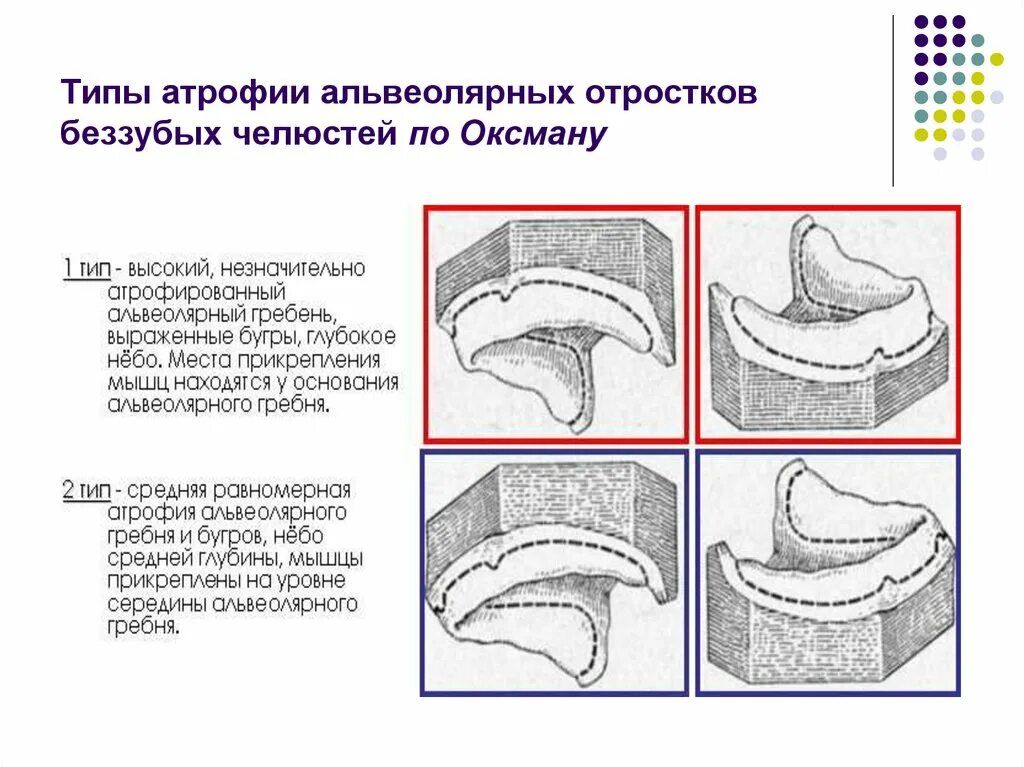 Зоны податливости слизистой. Классификация по Оксману нижняя челюсть. Типы атрофии альвеолярного отростка. Оксман классификация беззубых челюстей. Атрофия альвеолярного отростка классификация.