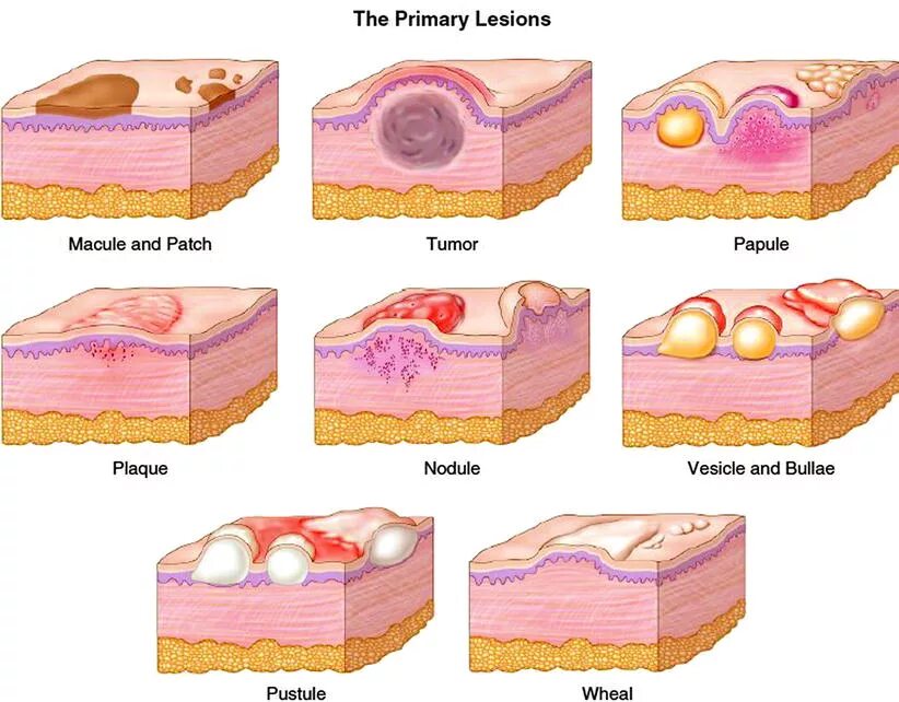 Слизистые покровы или гладкая поверхность. Ветрянка папула пустула. Ветряная оспа пятно папула везикула. Пятно папула везикула пустула язва.