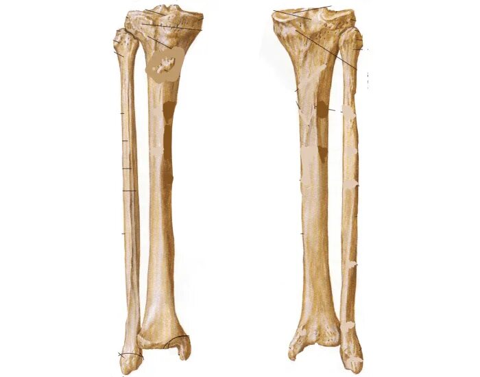Curved tibia fibula. Curved tibia fibula