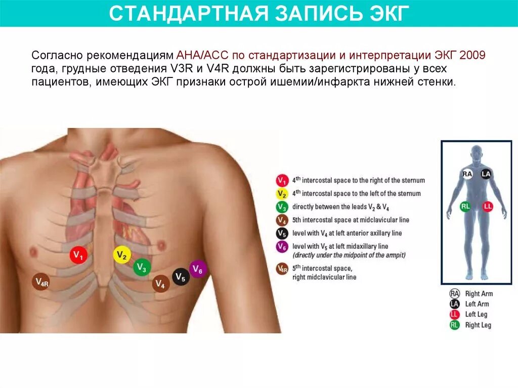 Крепление электродов ЭКГ. Электроды ЭКГ схема наложения. Схема накладывания электродов ЭКГ. Схема наложения электродов при снятии ЭКГ. Соп экг