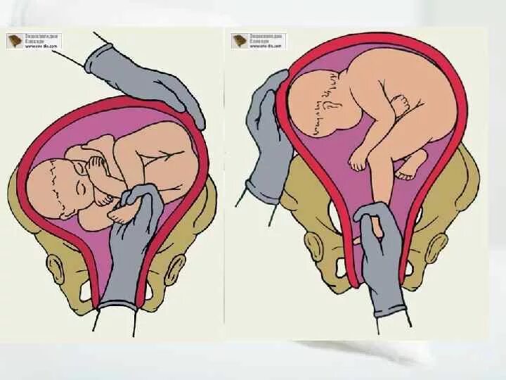 Прокол пузыря сколько схватки. Акушерский поворот плода на ножку. Внутренний поворот плода. Внутренний акушерский поворот. Наружно внутренний поворот плода.