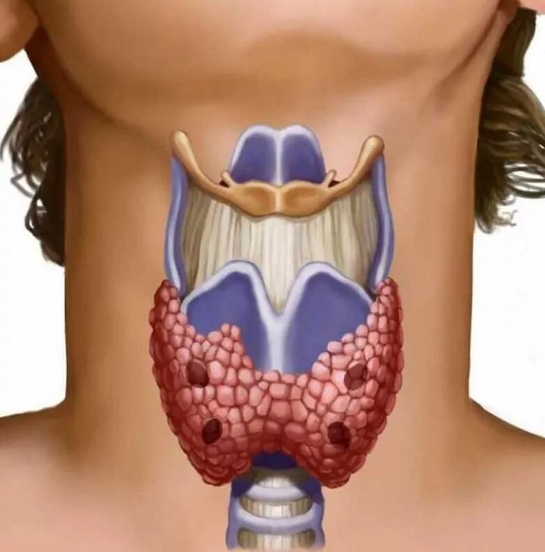 Зоб щитовидной железы болезни. Струма щитовидной железы. Многоузловой зоб гипотиреоз.