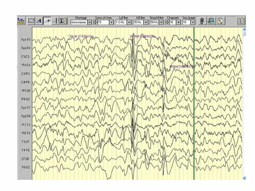 Как выглядит ээг. Гипервентиляция ЭЭГ. Топокартограммы ЭЭГ. Артефакт ЭКГ на ЭЭГ. Дизритмия на ЭЭГ.
