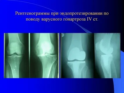 Коленный сустав ребенка 8 лет