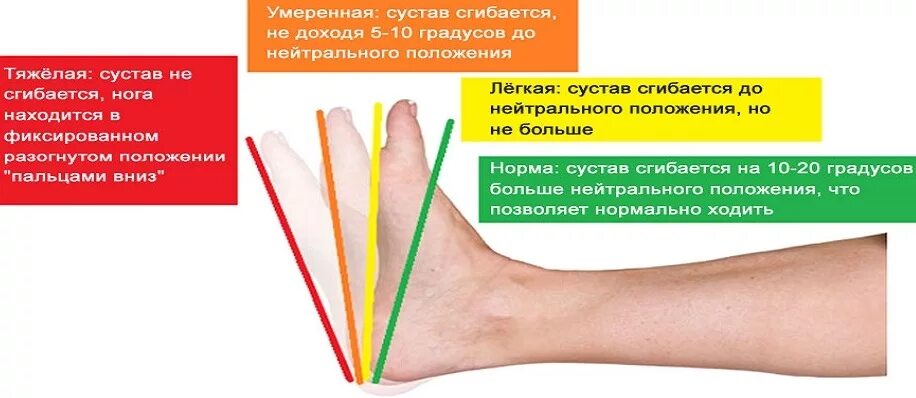 Сгибательная контрактура лучезапястного сустава. Степени контрактуры голеностопного сустава. Подвижность голеностопного сустава. Тыльное сгибание стопы в голеностопном суставе. Контрактура сустава код по мкб 10