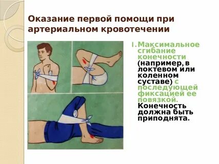 Альтернативный способ остановки артериального