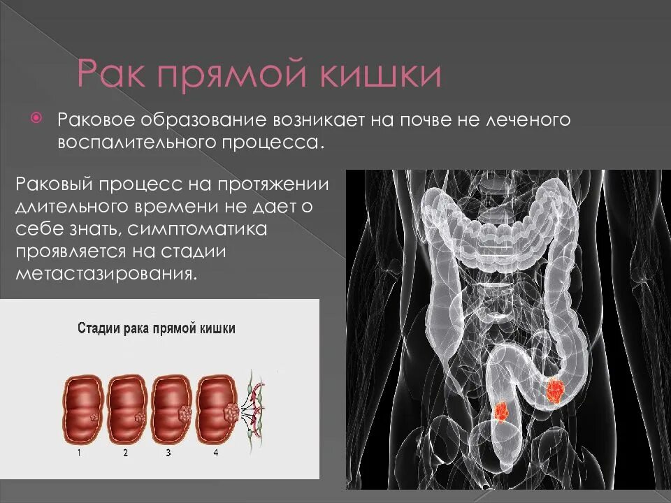 Ректальный рак. Новообразования в прямой кишке. Опухолевые заболевания прямой кишки.