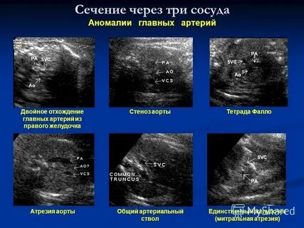 Транспозиция плода