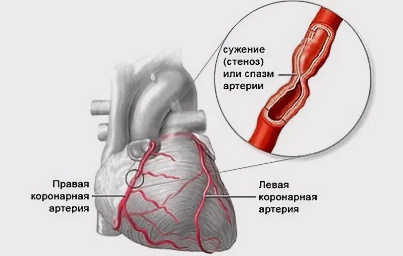 Спазм венечных артерий. Стенокардия Принцметалла. Стеноз коронарных артерий. Спазм коронарных сосудов. Стеноз прямой