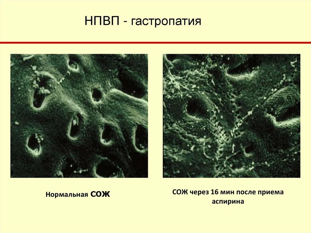 Признаки эритематозной гастропатии. НПВС индуцированная гастропатия. НПВП ассоциированная гастропатия. Терапия НПВП гастропатии. Лечение НПВС гастропатии.