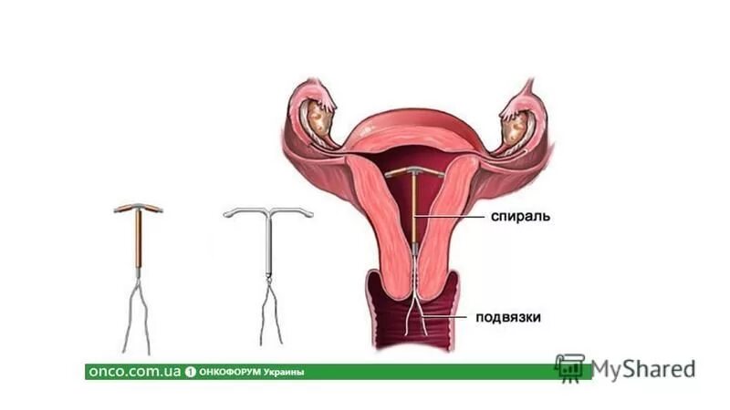 Гормональная внутриматочная спираль. Крови после установки спирали мирена