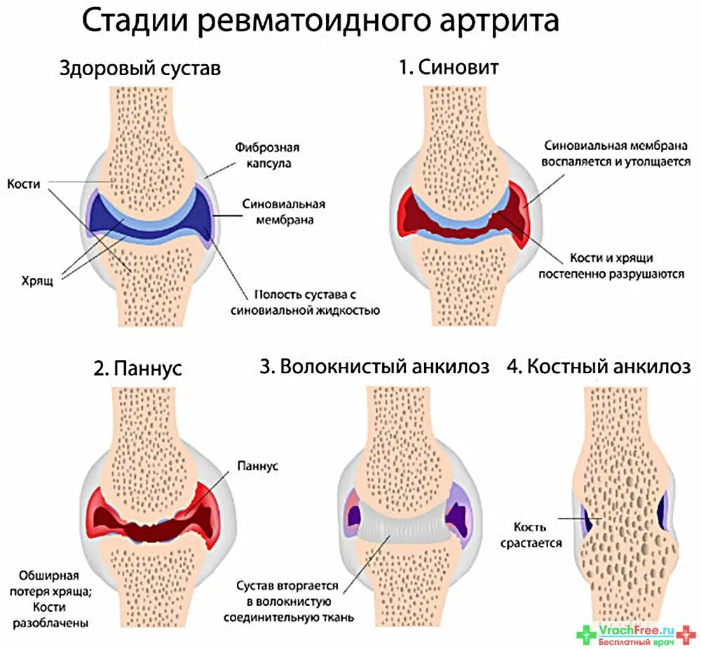 Артроз коленного сустава 1 степени что это