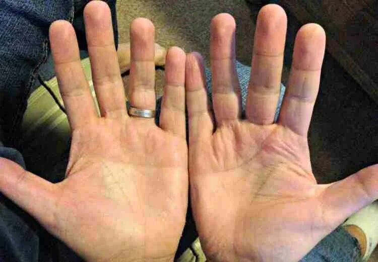 синдром дауна пальцы