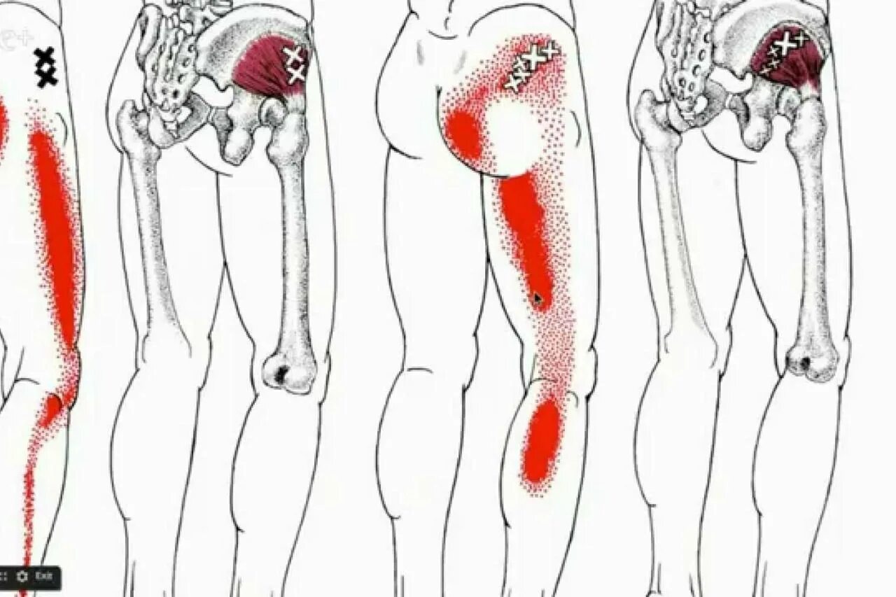 Почему боль отдает в ногу. Триггерные точки седалищного нерва. Грушевидная мышца поясницы триггерные точки. Синдром грушевидной мышцы триггерные точки. Триггерные точки бедра.