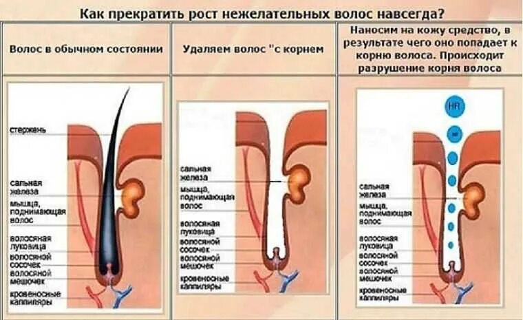 Избавление от волос навсегда. Как удалить волосы навсегда. Нежелательные волосы навсегда. Удаляем нежелательные волосы. Депиляция воском против роста или по росту