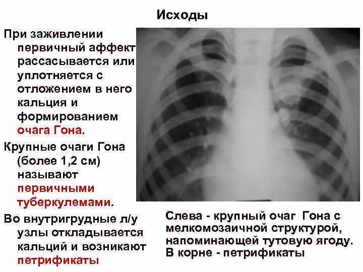 Очаг симон. Первичный туберкулезный комплекс очаг гона. очаг гона на рентгенограмме. первичный туберкулез очаг гона. кальцинированный очаг гона в легких.