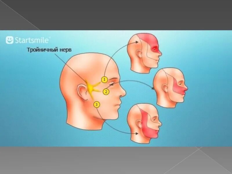 Тройничный нерв мигрень. Воспаление троичногоинерва. Воспаление третичного нерва. Воспаление тройничного нерва в челюсти. Болит голова и щека