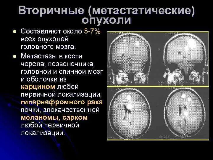 Лечение метастазов мозга. Первичные и вторичные опухоли головного мозга. Метастатические опухоли головного мозга. Вторичные новообразования головного мозга.