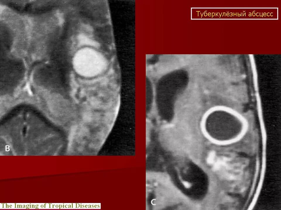 Мозговой туберкулез. Туберкулема головного мозга на кт. Туберкулема головного мозга мрт. Туберкулез головного мозга кт.