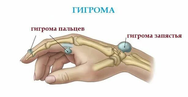 Код мкб гигрома кисти