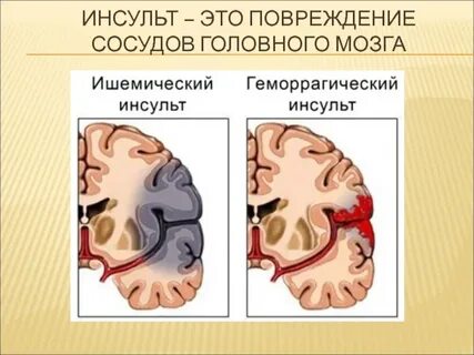 Разрыв сосуда