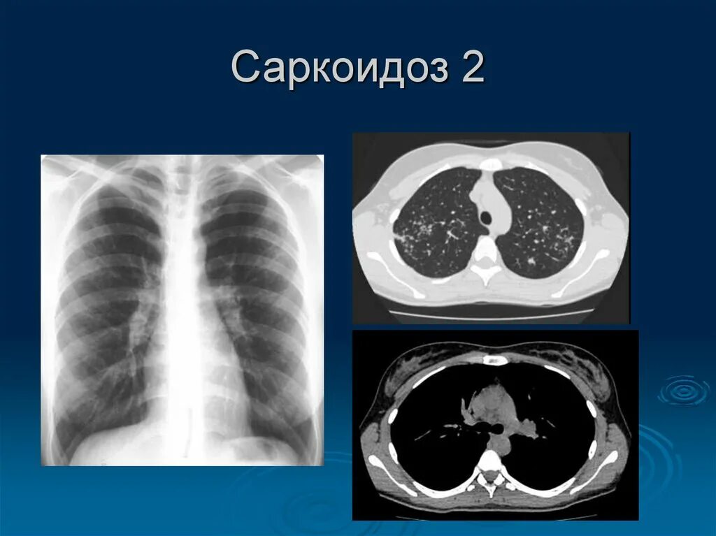 Саркоидоз лёгких 2 степени кт. Саркоидоз легких 2 стадия рентген. Медиастинально-легочный саркоидоз. Диагноз с 2 легкого