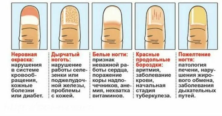 Болят ногти как снять боль Культура Педикюра. Копейск. ВКонтакте