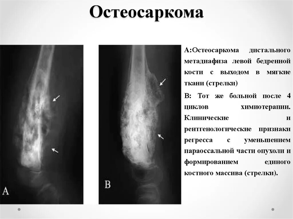 Виды сарком. Остеосаркома 4 стадии бедренной кости. Хондросаркома рентген бедренной. Остеосаркома кости рентген. Остеосаркома локтевой кости.