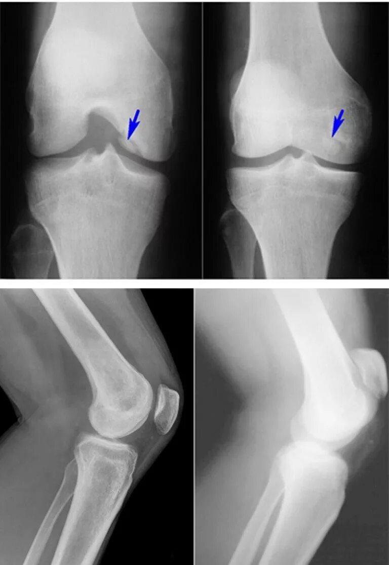 Асептический некроз мыщелка. Асептический некроз коленного кости. Асептический некроз мыщелков бедренной кости. Асептический некроз коленного сустава. Некроз кости на рентгенограмме.