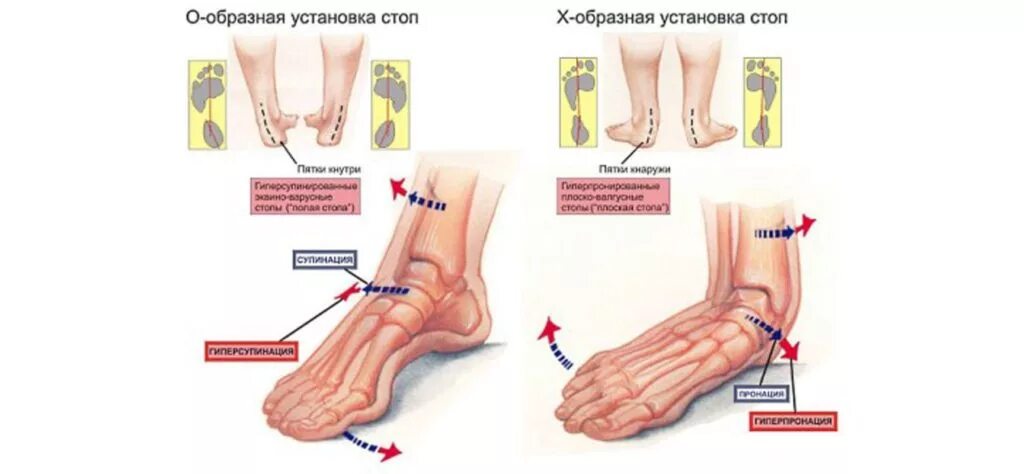 Степени деформации стопы. Продольное плоскостопие. Плоскостопие высота свода стопы. Деформация стопы при плоскостопии. Деформация стопы при плоскостопии.