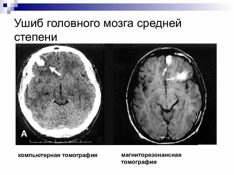 Тяжести сотрясения. Ушиб головного мозга средней степени тяжести. Ушиб головного мозга средней степени тяжести кт. Ушиб головного мозга средней степени кт. Ушиб ГМ легкой степени.