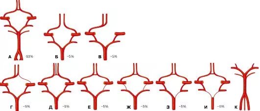 Аномалии Виллизиева круга варианты. Варианты строения Виллизиева круга. Аномалии развития виллизиевого круга. Аномалия сосудов Виллизиева круга.